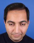After Hair Transplant&nbsp;Front